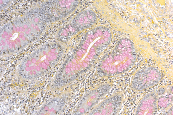 Mucicarmine kit - staining